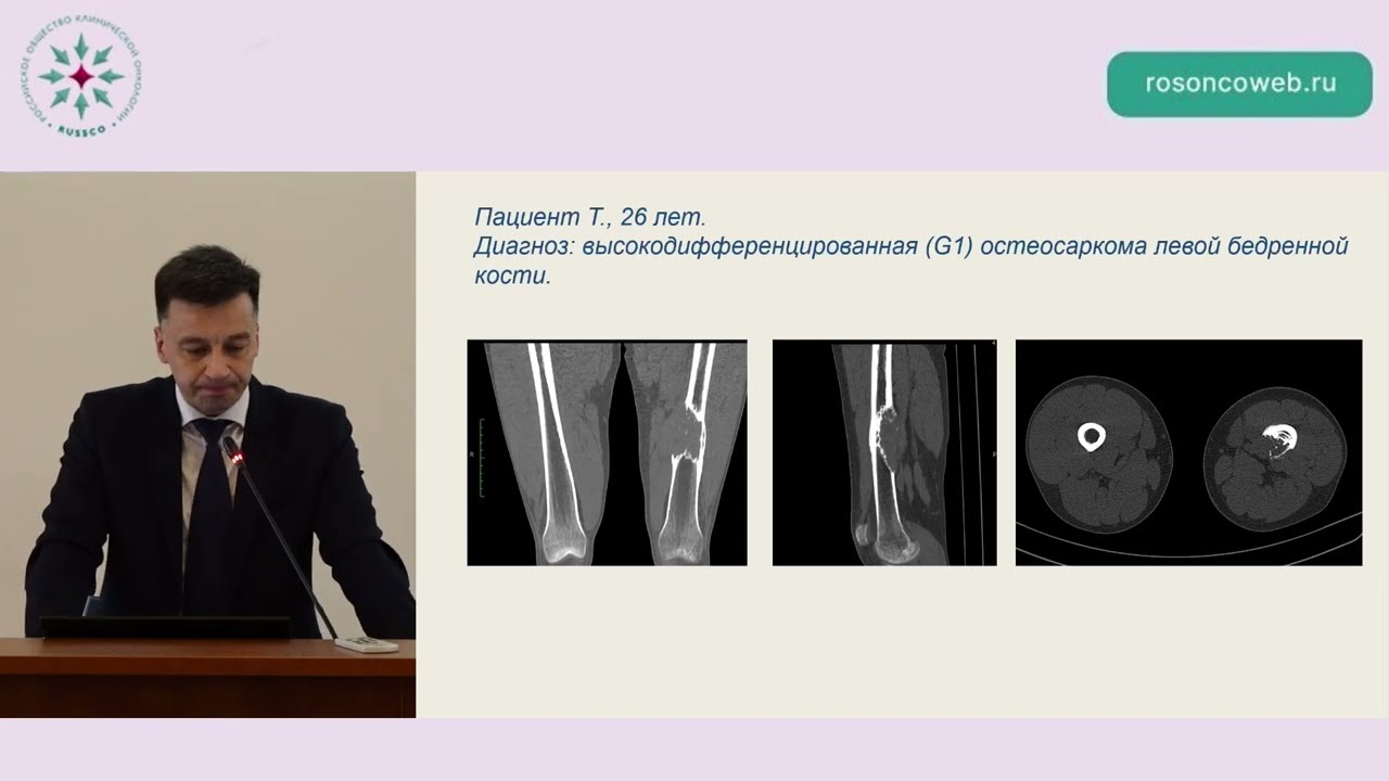 Высокодифференцированная остеосаркома. Расхождение морфологии и клиники – кто сильнее