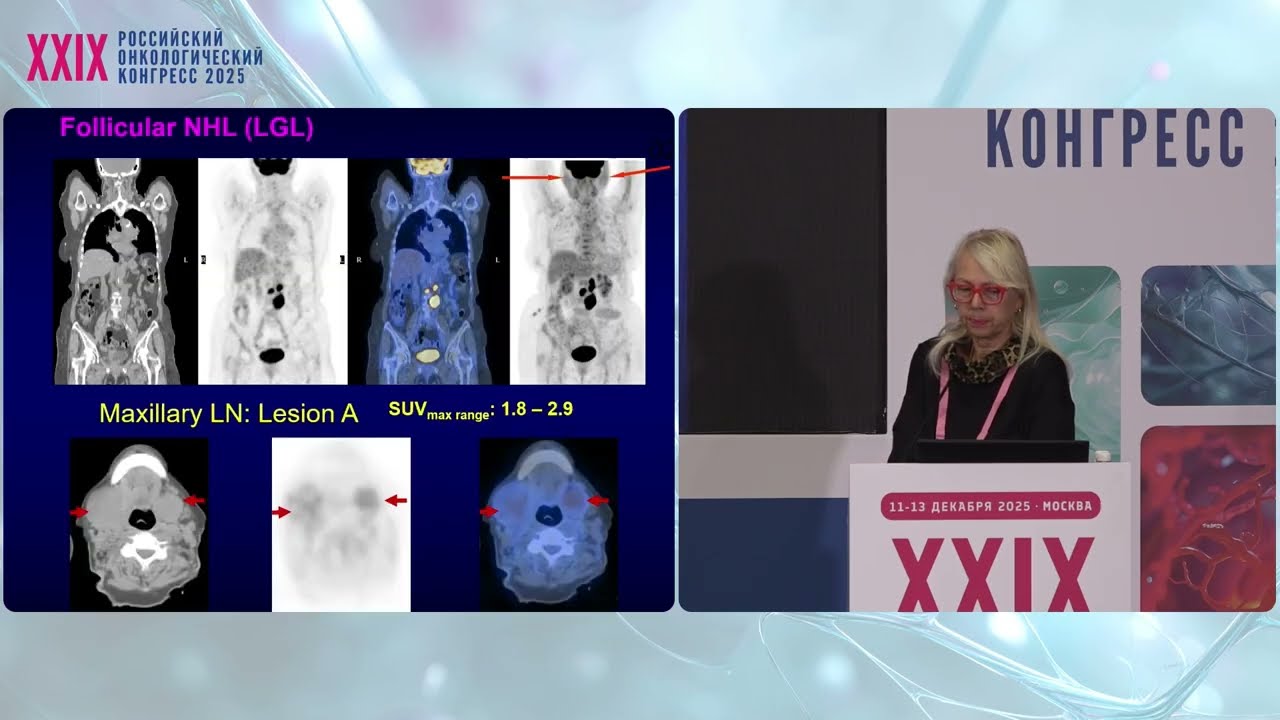 ФДГ ПЭТ-КТ в практике онколога: всегда ли отвечает на поставленные вопросы или нередко создает новые