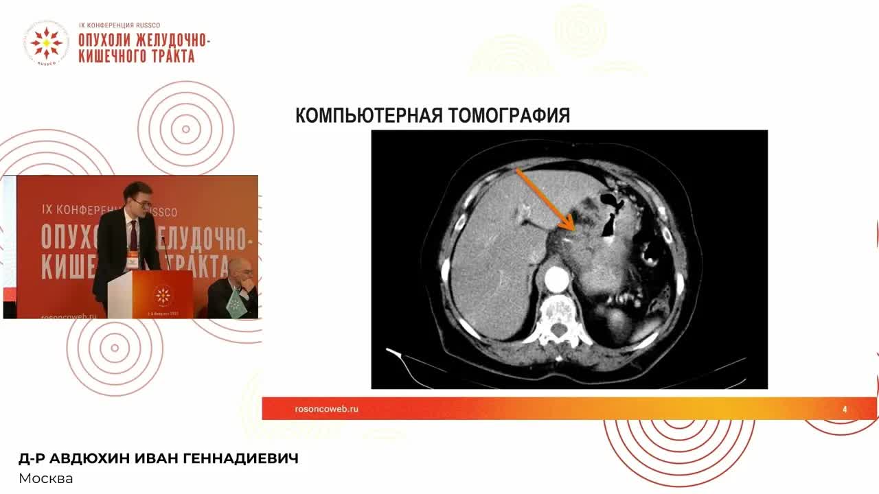 Забрюшинная лимфаденопатия у пациента с местнораспространенным раком желудка. Разбор кл.случая
