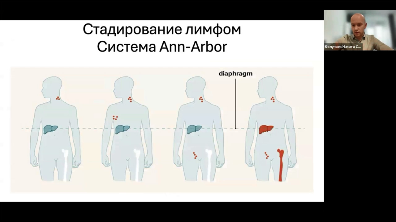 Академия RUSSCO для подготовки к экзамену ESMO: Лимфома Ходжкина (12 октября 2025)