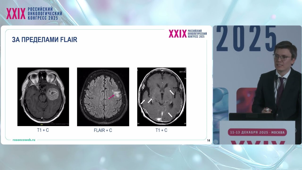 Метастатическое поражение головного мозга: принципы диагностики и раннего вмешательства