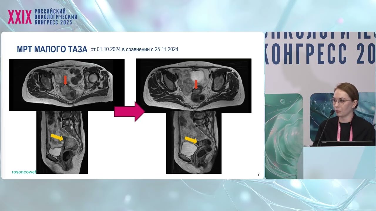 Редкие варианты эндометриоз-ассоциированных опухолей