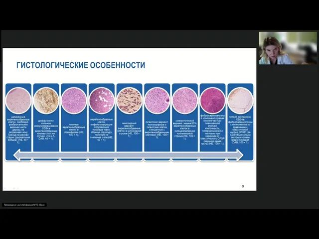 Редкие опухоли Дерматофибросаркома (вебинар 16 октября 2024)