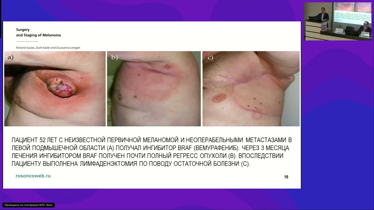  Хирургическое лечение меланомы – лимфаденэктомия: кому и когда?