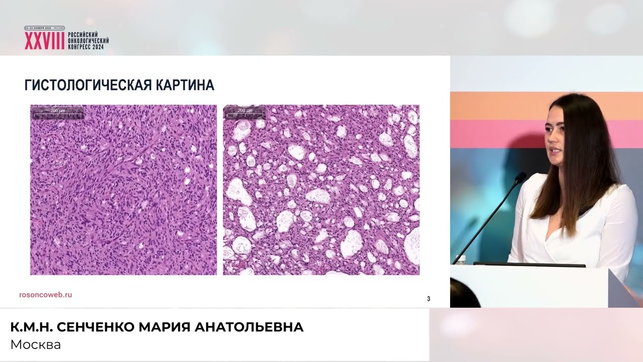 Редкая эмбриональная опухоль головного мозга у ребёнка