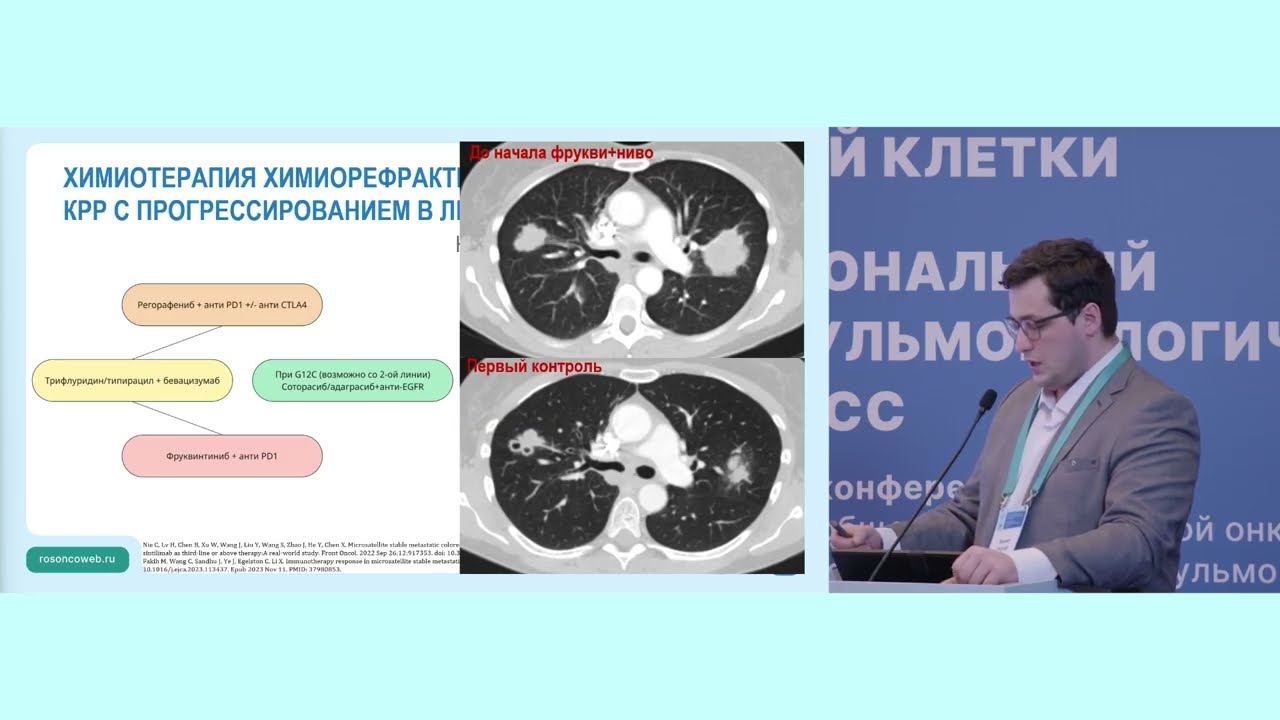 Особенности лечения метастазов колоректального рака в легких