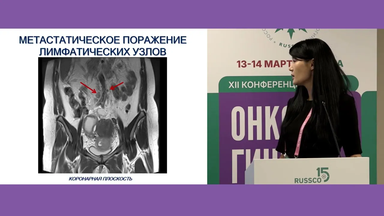 Точка невозврата I: где диагностическая ошибка лишает радиотерапию радикальности