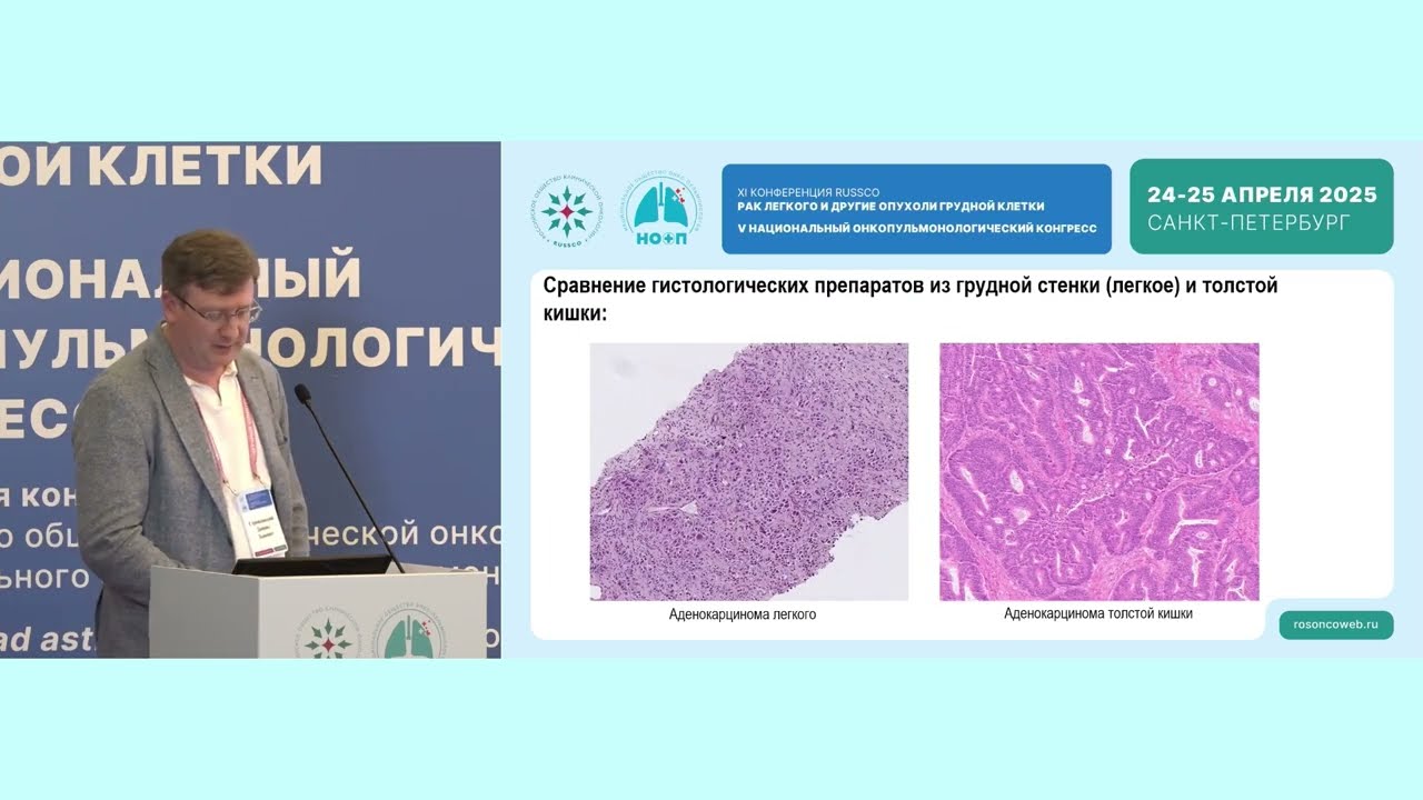 Разбор клинических случаев по раку легкого. Дискуссия с химиотерапевтом