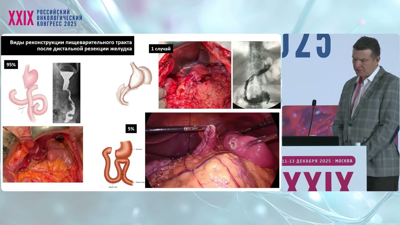 Реконструкция желудочно-кишечного тракта в хирургии рака желудка и пищевода