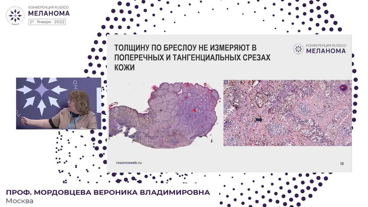 Морфолог: практические проблемы диагностики меланомы и меланоцитарных образований