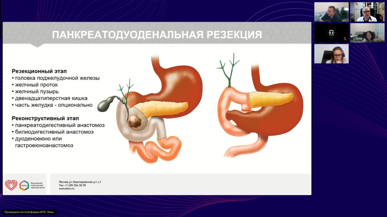Рак поджелудочной железы (вебинар 10 октября 2025)