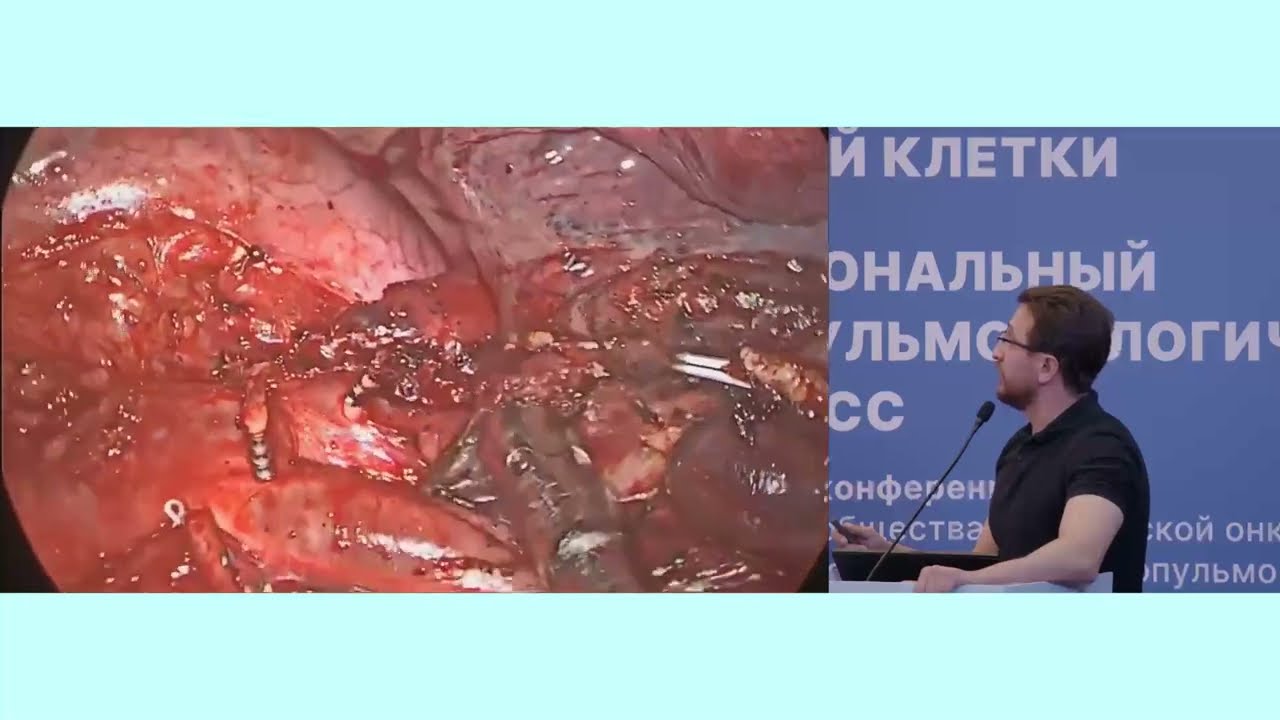 Лечение метастазов в легких при опухолях органов мочевыделительной и репродуктивной системы