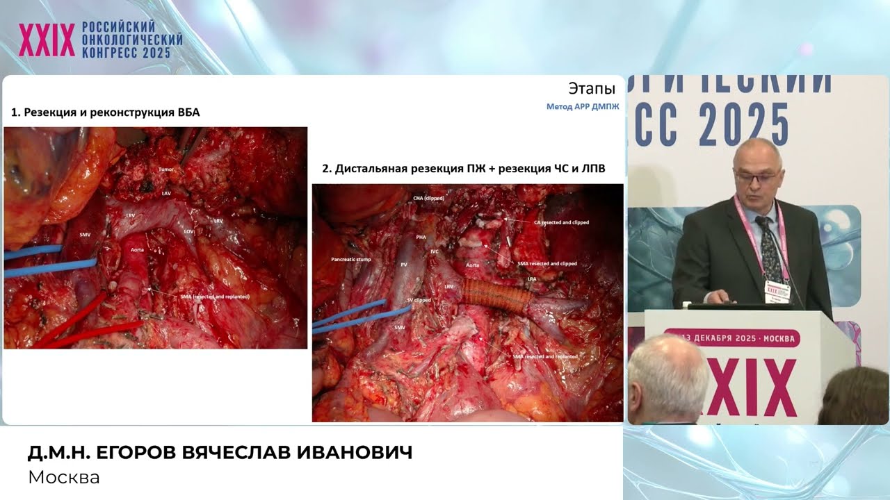 Артериальные и венозные резекции при протоковой аденокарциноме поджелудочной железы