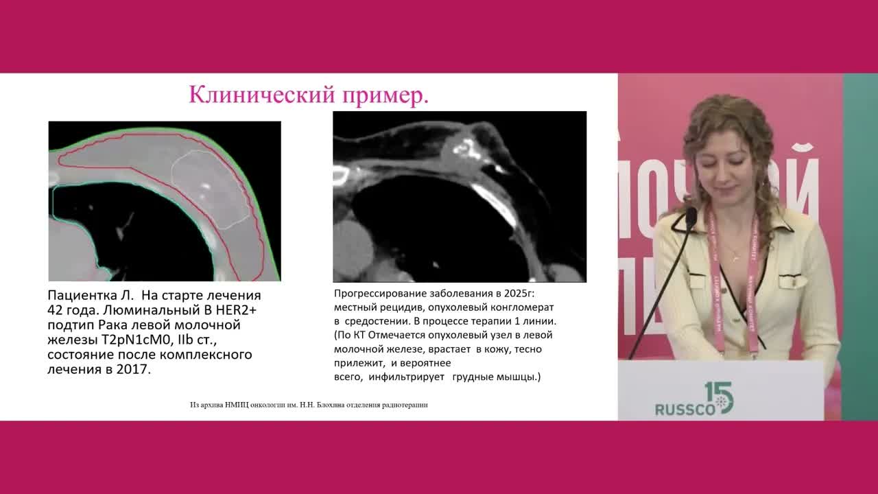 Буст ложа опухоли: когда «добавить дозу» – стандарт контроля, а когда это лишний фактор фиброза