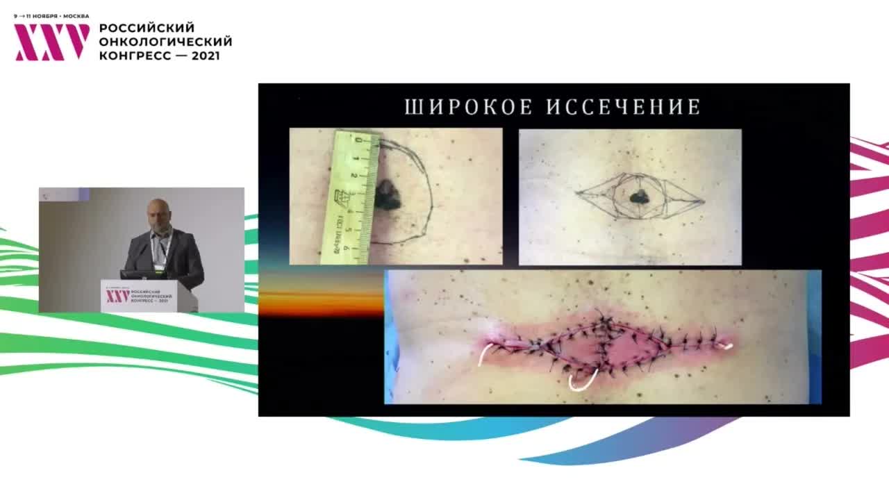 Меланома: биопсия сторожевых лимфоузлов