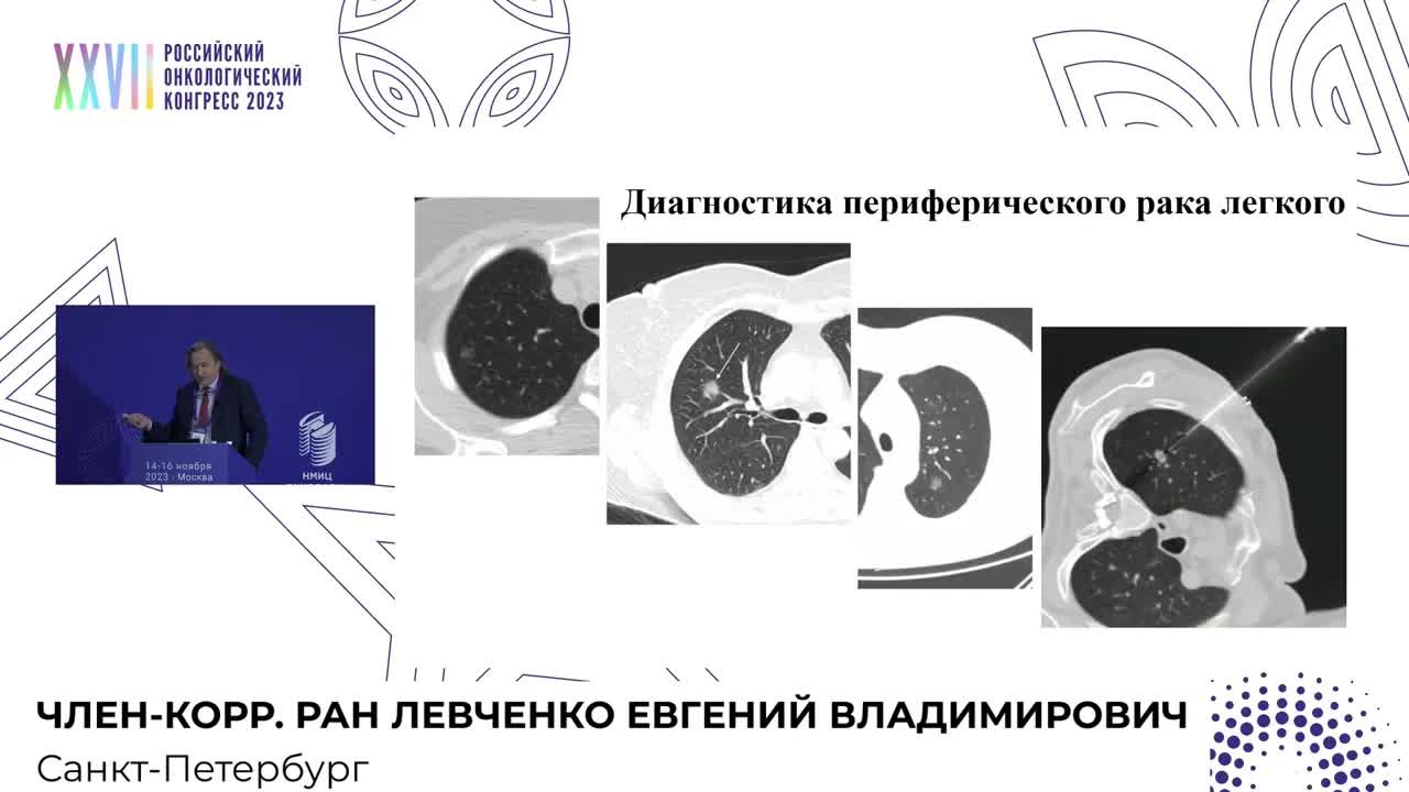Биопсия сторожевого лимфоузла при раке легкого