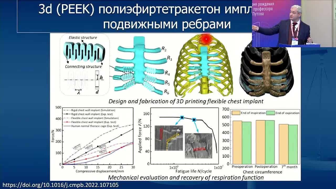 Закрытие дефектов грудной стенки после резекций по поводу опухолей