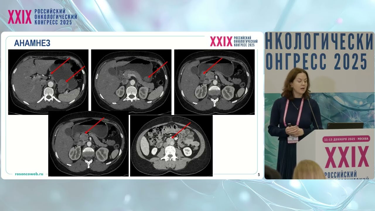 Клинический случай ГИСО желудка. Взгляд онколога