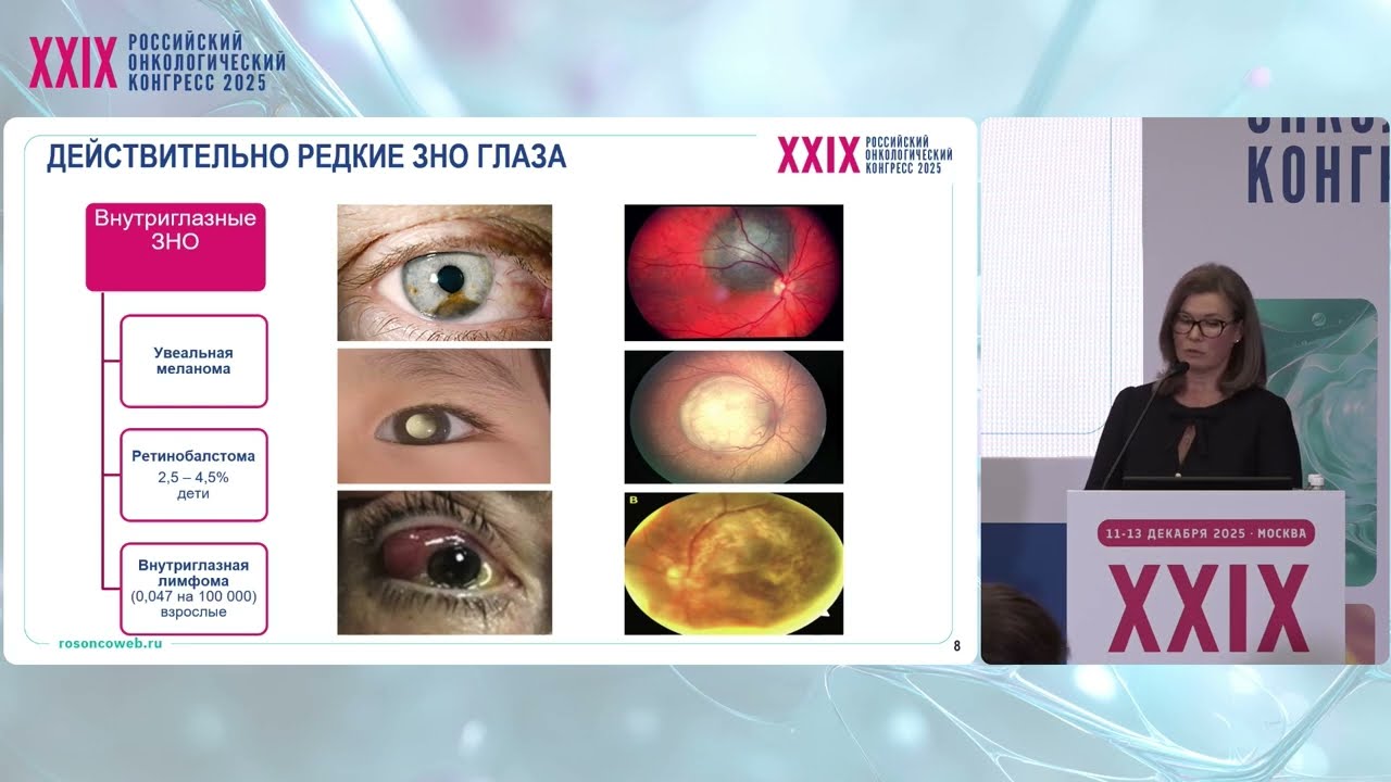 Опухоли глаза