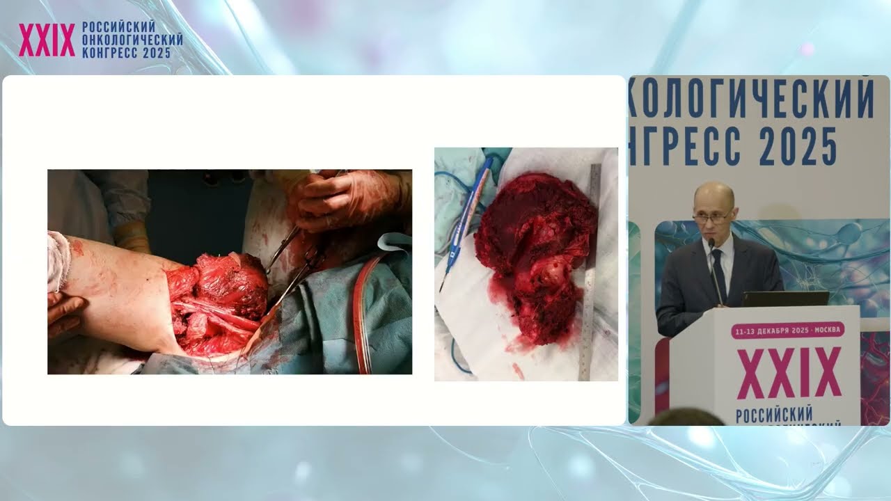 Сложная хирургия опухолей таза. Вовлечение костных структур таза, какие есть лимиты