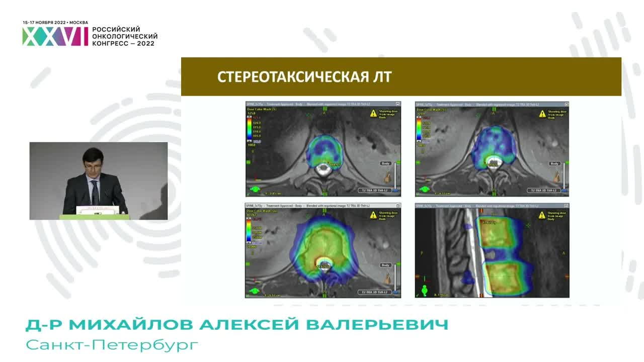 Стереотаксическая лучевая терапия при костных метастазах