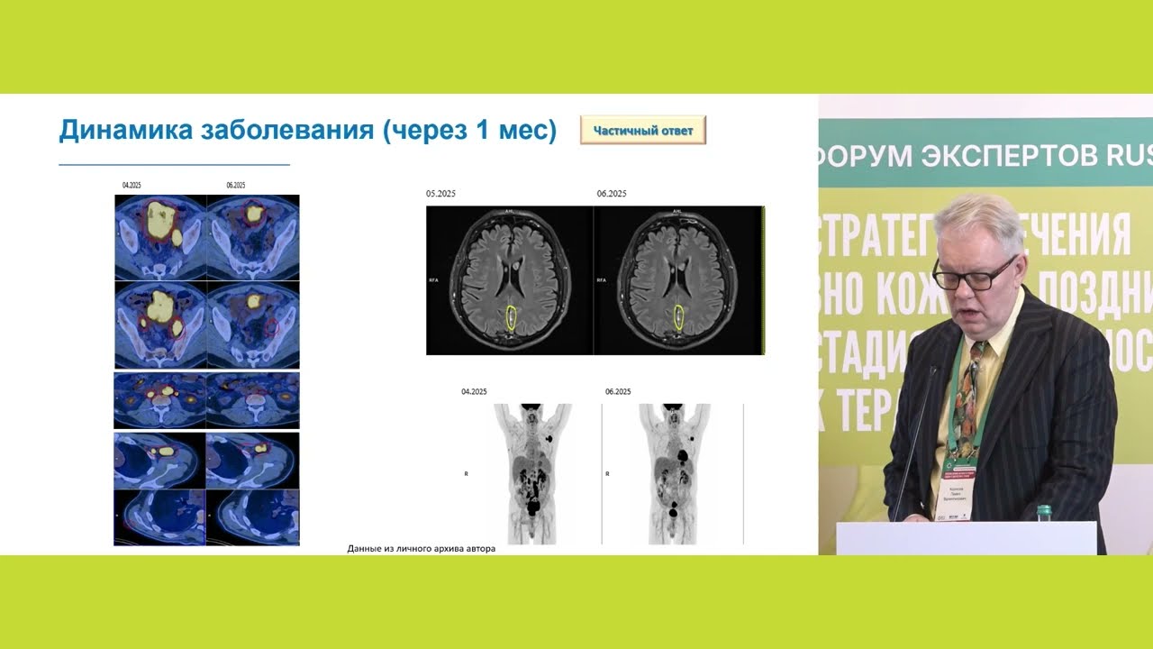 Клинический случай пациента с меланомой