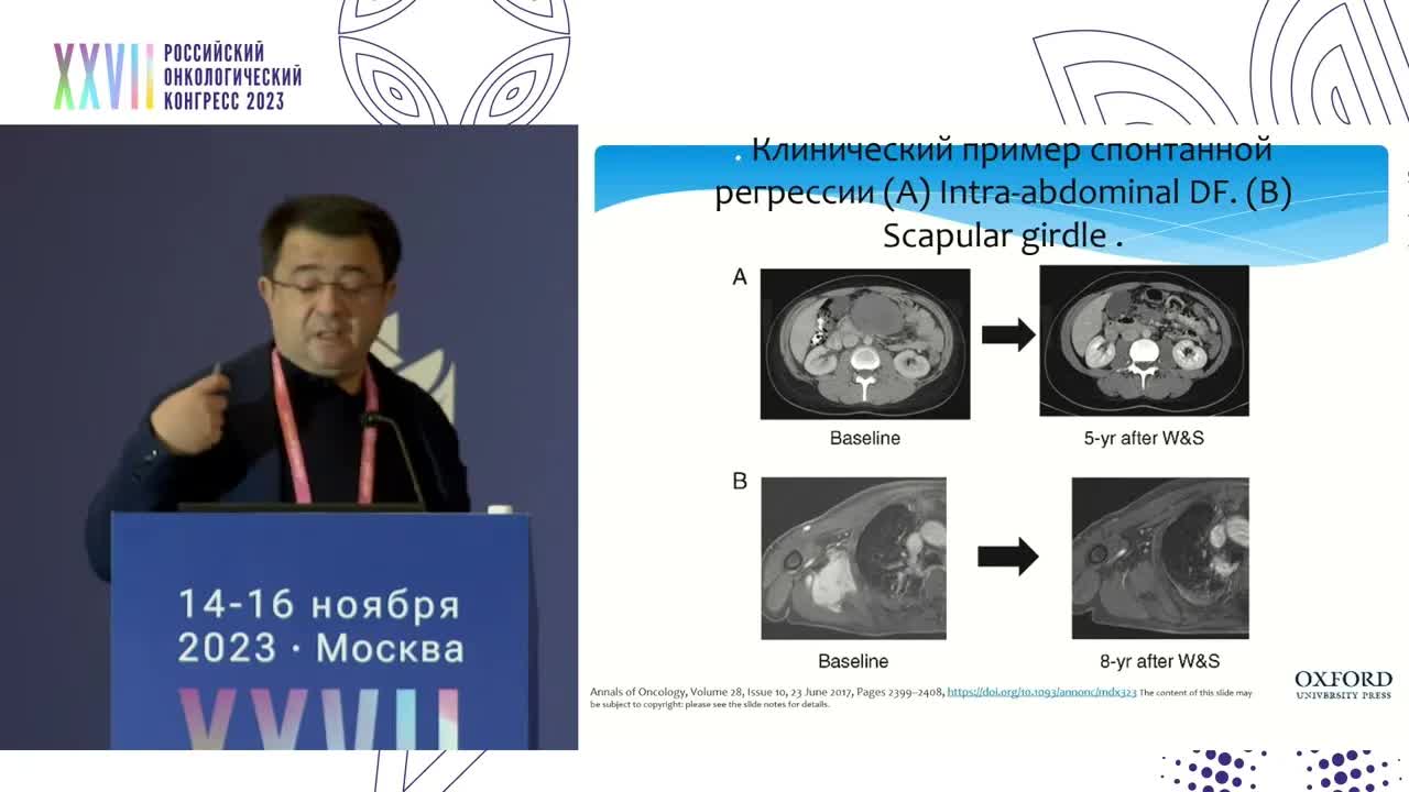 Тактика лечения операбельного агрессивного фиброматоза (десмоид)