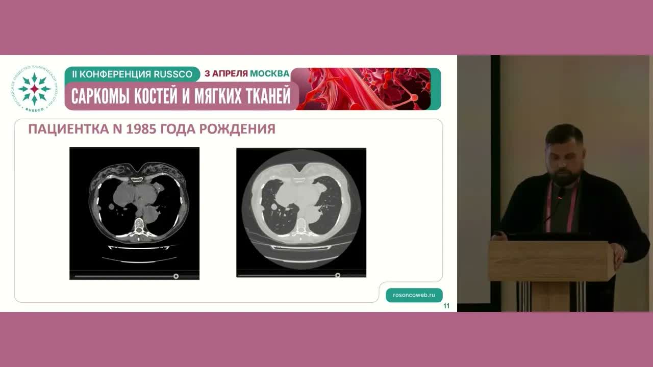  Клинический случай лечения саркомы мягких тканей левого бедра