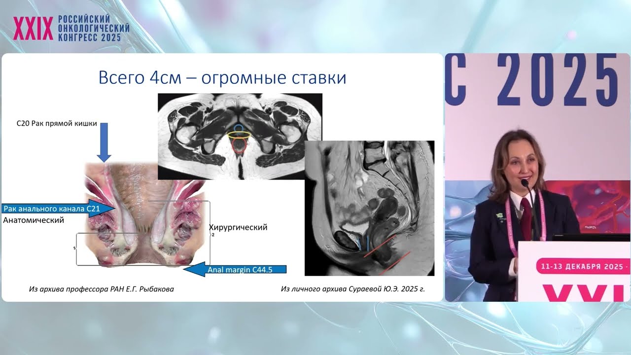 Рак анального канала: диагноз, не прощающий ошибки радиотерапевта