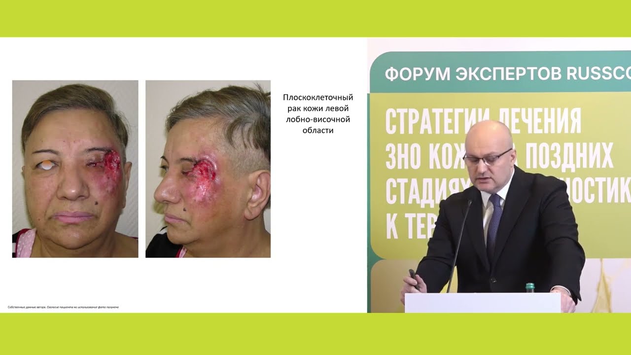 Мультидисциплинарный подход в терапии ЗНО кожи поздних стадий